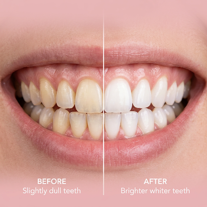Before and after teeth whitening with LumaGlow